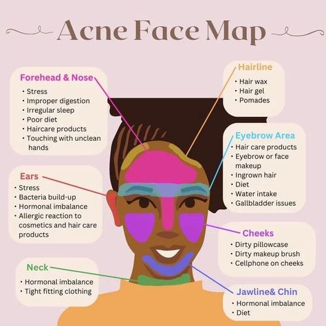 Acne Face Map: Causes for Clear Skin ⬇️⬇️⬇️ Discover the secret language of your skin with the acne face map! This connects specific areas of your face to underlying causes of acne. In this post, we'll explore the face map, uncovering key regions and preventive acne methods. The mysteries of acne with the face map. From hormonal imbalances on the forehead to hygiene habits affecting the cheeks, each area tells a unique story. Excess oil production in the T-zone? We'll show you how to balan... Acne Face Map, Cheek Acne, Face Map, Hair Diet, Causes Of Acne, Different Types Of Acne, Face Mapping Acne, Acne Diet, Skincare Habits