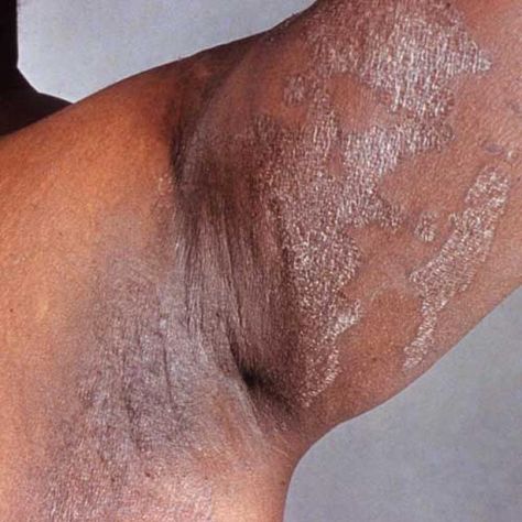 9 Common Skin Infections That Cause a Rash: Erythrasma Skin Rash Remedies, Home Remedies For Rashes, Clinic Poster, Fungal Rash, Fungal Infection Remedies, Rashes Remedies, Fungal Infection Skin, Home Remedies For Skin, Bacterial Infection