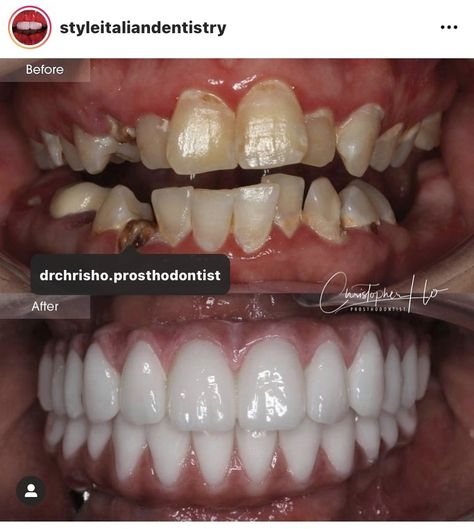 Porcelain Veneers before and after by styleitaliandentristry . Veneers Before And After, Composite Veneers Teeth, Veneer Teeth Inspiration, Composite Veneers Before And After, Porcelain Veneers Before And After, Teeth Makeover, Teeth Veneers, Cosmetic Dentistry Veneers, Tooth Care