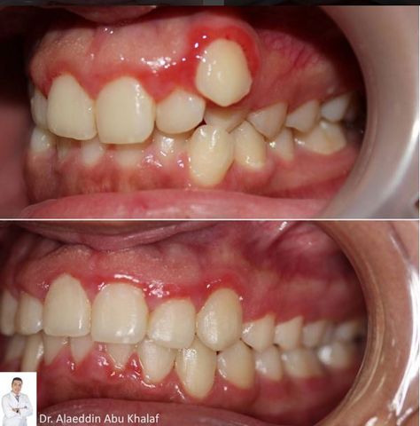 Canine Tooth, Dental Center, Tooth Extraction, More Information