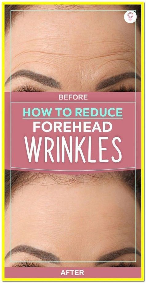 Forehead Wrinkles Remedies, Reduce Forehead Wrinkles, Wrinkles Remedies Face, Wrinkle Remedies, Wrinkle Free Skin, Radiant Beauty, Facial Wrinkles, Body Stretch, Forehead Wrinkles