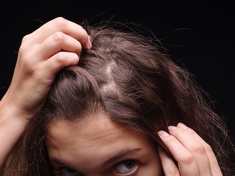 Trichotillomania | Hair Pulling Disorder | TLC Foundation for BFRBs Skin Picking Disorder, Nail Picking, Bald Spot, Hair Pulling, Chronic Condition, One Hair, Body Hair, Grow Hair, About Hair