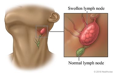 Many of you have started your detox journey and have been having very uncomfortable detox symptoms. You are probably wondering if what you are feeling is norma Ear Popping, Low Thyroid Remedies, Detox Symptoms, Thyroid Remedies, Lymph Node, Flush Out Toxins, Drainage Massage, Low Thyroid, Lymph Massage