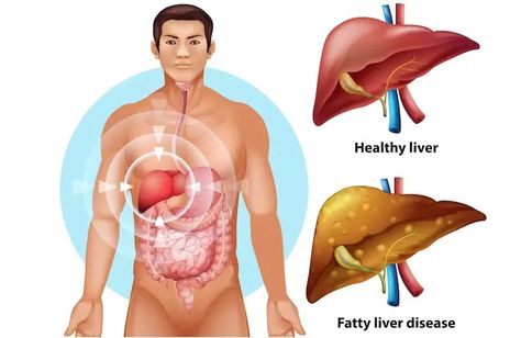 What is the life expectancy with fatty liver disease? Learn the risk factors, prevention, and strategies for managing fatty liver disease (Both AFLD and NAFLD). Where Is Your Liver Located, Liver Diet Plan, Healthy Liver Diet, Liver Failure, Liver Diet, Liver Detoxification, Liver Detox, Life Expectancy, Liver Health