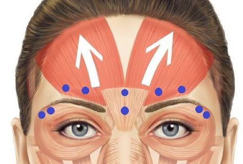 Thinking about a non-surgical eyebrow lift?  The blue dots indicate some of the common injection sites of Botox to lift the brow. Botox Injection Sites, Botox Brow Lift, Botox Before And After, Eyebrow Lift, Botox Cosmetic, Facial Yoga, Nose Surgery, Facial Aesthetics, Botox Fillers