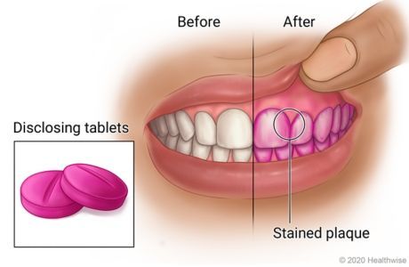 Disclosing Tablets, Plaque Teeth, Medical Library, Dental Plaque, Emergency Medicine, Dental Hygiene, Oral Care, Tablet, Medical