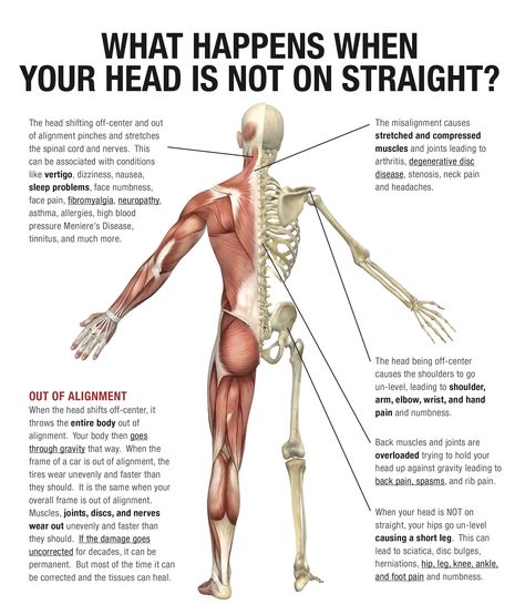 What symptoms show up for you when you are out of alignment? What improvements do you feel following a spinal correction? For some people the misalignment shows up as headaches, neck pain, tension in the shoulders, twisting of the body framework, low back pain, hip pain, joint discomfort, leg pain, or as some say a “hitch in their get along.” And for others it can be a neurological issue. When the body is out of alignment it can manifest in many different ways. Forward Head Posture Exercises, Shoulder Pain Exercises, Body Wisdom, Arthritic Pain, Forward Head Posture, Yoga Anatomy, Spine Health, Muscle Anatomy, Leg Pain