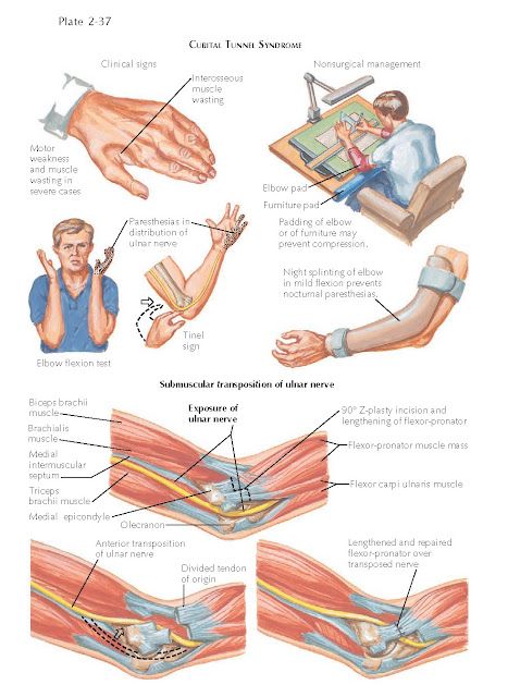 Submuscular transposition of ulnar nerve Cubital Tunnel Syndrome, Ulnar Nerve, Nerve, Bones Funny, Anatomy