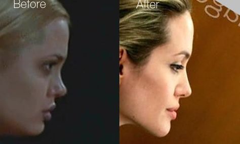 Angelina Jolie Profile - Before & After Chin Implant and Nose job. Lots of plastic surgery on this woman! Angelina Jolie Profile, Angelina Jolie Nose Job, Angelina Jolie Nose, Square Jaw, Forehead Lift, Chin Implant, Clear Healthy Skin, Facial Plastic Surgery, Brow Lift