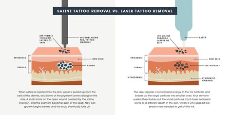 Saline Tattoo Removal, Paramedical Tattoo, Pulse Tattoo, Eyebrow Tattoo Removal, Ink Removal, Tattoo Removal Cost, Laser Removal, Pen Tattoo, White Ink Tattoo