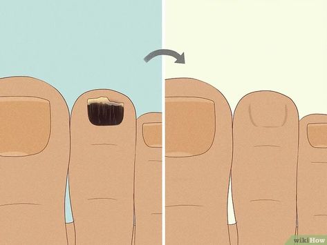 Black Spot On Toenail, Black Toenail Fungus, Nail Symptoms, Toenail Health, Black Toe Nails, Nail Remedies, Toenail Fungus Remedies, Nail Problems, Nail Fungus Remedy