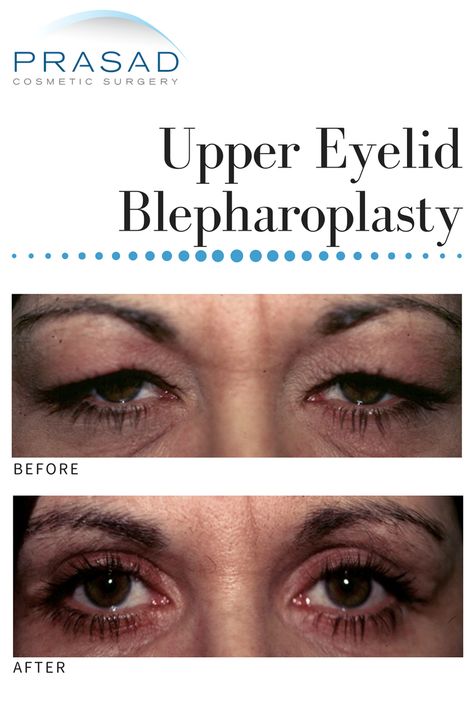 Before and After: Upper Eyelid Blepharoplasty Eye Lift Before And After, Upper Eye Lid Surgery Before And After, Upper Eyelid Lift Surgery, Eyelid Lift Surgery Before After, Eye Lid Surgery Before And After, Eye Lid Lift Droopy Eyelids, Lower Bleph, Eye Lid Surgery, Eye Bag Surgery