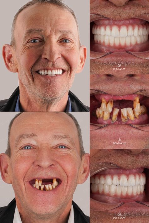 all on 6 implant,  bridge implant , dental implant , front tooth missing . Dental Animation, Eid Mubarak Photo, Dental Photos, Hollywood Smile, Medical Animation, Dental Implant, Dental Implants, Eid Mubarak, Dental Care