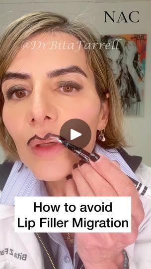 80K views · 1.8K reactions | The black lipliner represents the vermillion border.  Placement of lip filler above or along this line with techniques such as tenting can lead to migration.  Filler above this border can lead to projection of the upper lip and cause an undesirable duck lip 🦆effect.  Small linear threads along the natural lip pillows is best…specially in the areas that are concave or have volume loss. 

Too much filler placed in the lips can also spill above this natural border and cause migration. 

Choosing the right consistency of filler can prevent filler migration.  Fillers that are too soft and runny can increase risk migration. 

Always, conservative treatments are best. 

#fillermigration #lipfiller #lipfillermigration #fillertraining #drbitafarrell #naturalaestheticsc Lip Filler Injection Sites, Lip Border Definition Filler, Lip Filler On Small Lips, Natural Looking Lip Fillers, Pouty Lip Filler, Lip Filler Styles, Lip Filler After Care, Lip Fillers Before And After 1ml, 1 Syringe Lip Filler