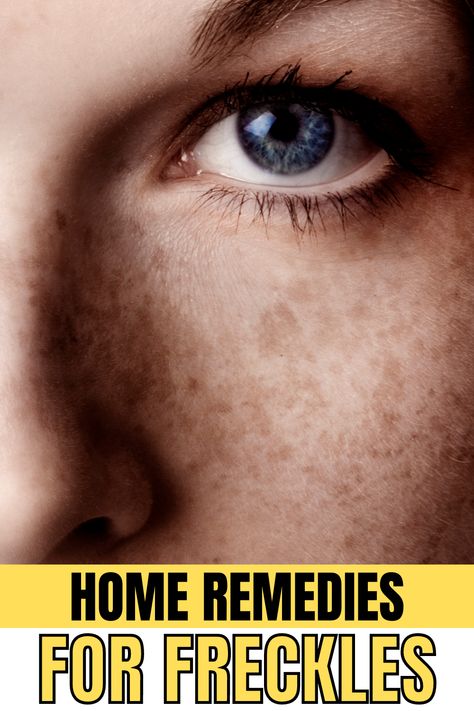 Remove Freckles From Face, How To Get Rid Of Freckles, Freckles On Arms, How To Remove Freckles, Getting Rid Of Freckles, Freckle Remover, Skin Care Home Remedies, Face Peel, Chemical Peels