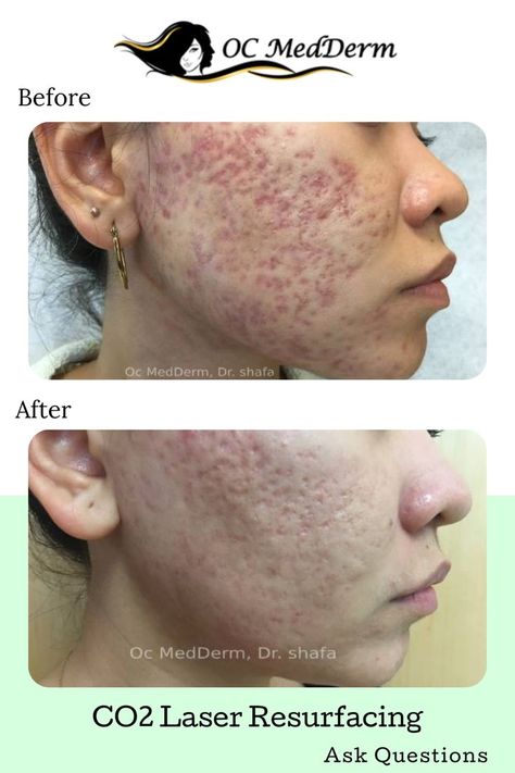 Co 2 Fractional Laser, Fractional Laser Before After, Acne Laser, Fractional Laser, Laser Resurfacing, Cosmetic Dermatology, Acne Scar, Skin Resurfacing, Laser Skin