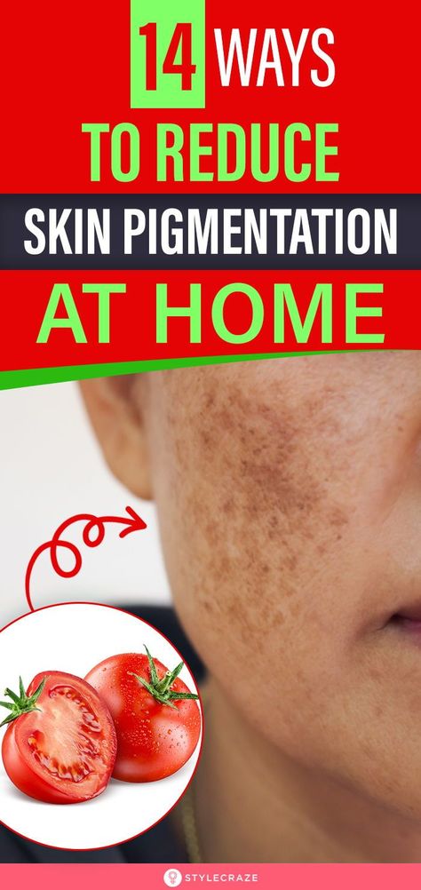 Pigmentation On Face, Pigmentation Remedy, Hair Fall Remedies, Clearing Hyperpigmentation, Beauty Skincare Aesthetic, Healthy Teeth Whitening, Hyperpigmentation Remedies, Skincare Face Masks, Glowing Skin Overnight