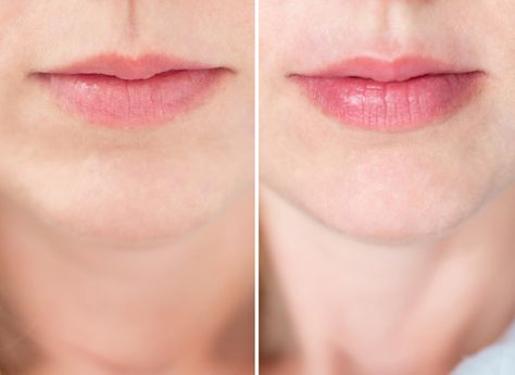 Before and after using the PMD Kiss Lip Plumping System. Swollen Lips After Kiss, Lip Plumper Device, Swollen Lips, Natural Skincare Routine, Drugstore Lips, Aesthetic Dermatology, Pmd Beauty, Lip Art Makeup, Pink Magic