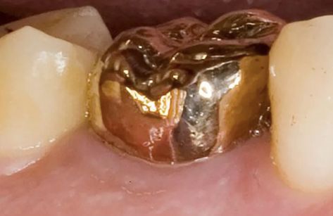 At one time, gold #dentalCrowns were all the rage. Nowadays, most people prefer the natural look you get from #allPorcelainCrowns. Here’s how the two stack up against each other. #BestDentistSurreyBC Permanent Gold Teeth, Tooth Crown, Gold Tooth, Tooth Repair, Dental Emergency, Emergency Dentist, Restorative Dentistry, Dental Veneers, Dental Cleaning