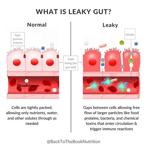 Everything you need to know about Leaky Gut - what causes it, how to know if you have it, and how to fix it naturally! #leakygut #guthealth #healthygut | Back To The Book Nutrition Leaky Gut Symptoms, Yeast Overgrowth, Digestive Juice, Cell Line, Gi Tract, Healthy Bacteria, Gut Bacteria, Stomach Acid, Leaky Gut