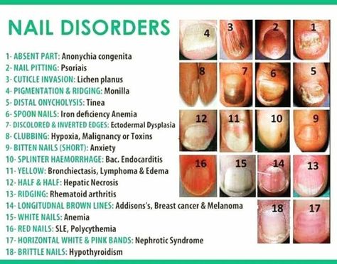 nail problems Vertical Nail Ridges, Fingernail Ridges, Nail Disorders, Nail Ridges, Nail Problems, Gray Nails, Heart Problems, Nail Bed, Nail Fungus