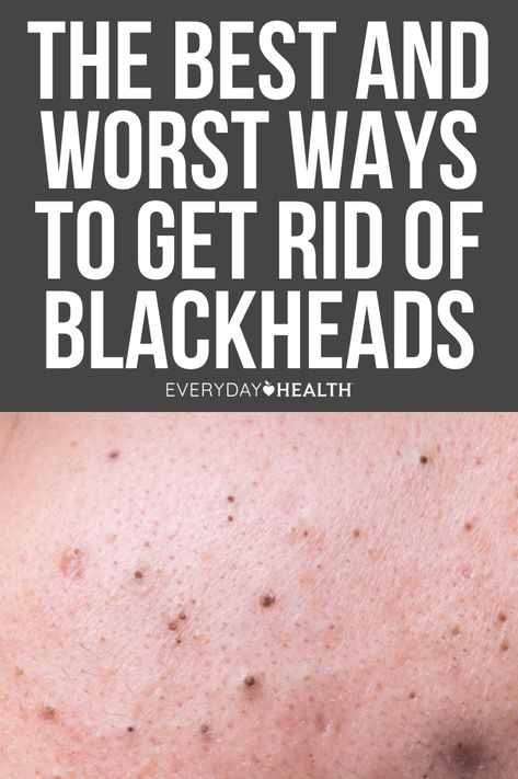 What Causes Blackheads? How to Prevent Blackheads on Your Skin The Best Ways to Get Rid of Blackheads The Worst Ways to Get Rid of Blackheads Acne comes in many shapes, sizes, and colors — and sometimes, the skin condition doesn’t look like an obvious blemish at all. Take blackheads, those pesky dark-colored gunk-filled spots. If you’ve ever tried squeezing one, you’ve probably found yourself facing down an angry bump instead and immediately regretted it. How To Get Rid Of Stubborn Blackheads, How To Get Rid Of Blackheads On Cheeks, Best Products For Blackheads, How To Get Rid Of Black Heads, How To Get Rid Of Blackheads, What Causes Blackheads, Blackheads On Back, How To Prevent Blackheads, Blackheads On Cheeks