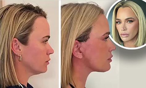 Teddi Mellencamp, 40, shares before and after photos of her neck lift Teddy Mellencamp, Neck Lift Before And After, Lower Face Lift, Teddi Mellencamp, Chiseled Jaw, Shoulder Length Blonde, Face Lift Surgery, Neck Lift, Under The Knife