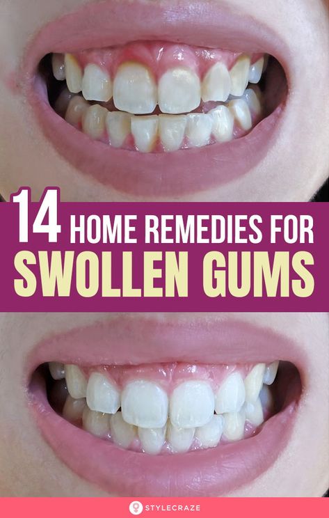 Swollen Gums Remedy, Grow Back Receding Gums, Fix Teeth, Tooth Infection, Remedies For Tooth Ache, Gum Inflammation, Swollen Gum, Tooth Pain, Teeth Health