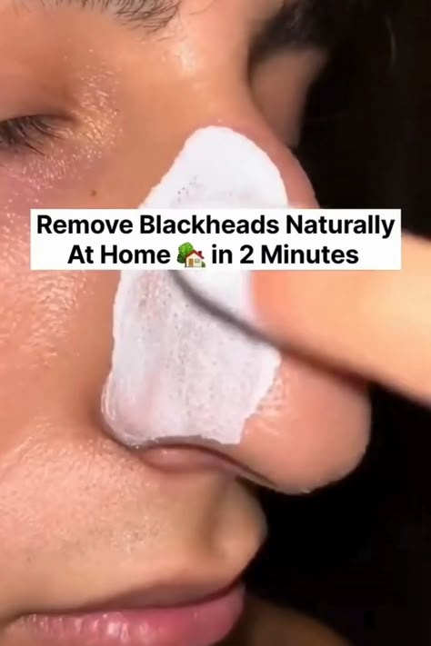 How to remove blackheads at home #black heads Remedy For White Heads On Face, How To Remove Black Heads From Face, Tips To Remove Blackheads, What Helps With Blackheads, How To Get Rid Of Pores At Home, Diy Facemask Skincare Blackheads, Natural Ways To Remove Blackheads, How To Get Rid Of Blackheads On Nose At Home, Natural Black Head Remover Diy