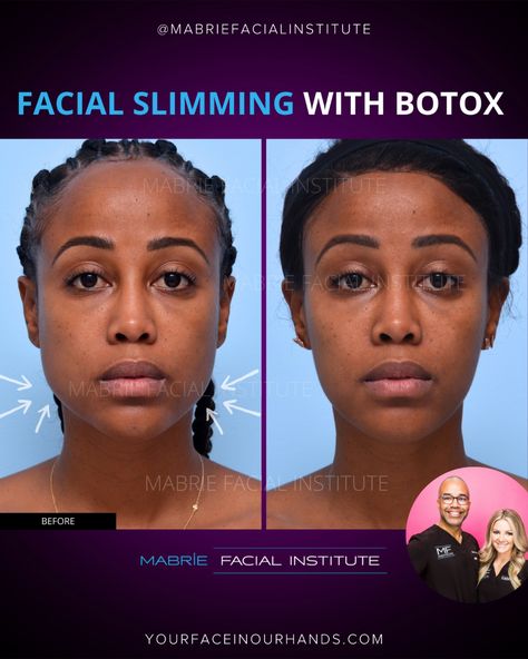 Whether your face is too round, too squared, or lacks definition, facial slimming with BOTOX can help you create or enhance your facial contours. GOALS COMPLETED: Slimmed masseter muscles Created subtle contour Enhanced Cheekbones RESULTS: This patient comes every 6 months for maintenance. Phone/Text/What's App: (415) 445-9513 Email: IG@drmabrie.com #nonsurgical #tmj #masseterbotox #injectables #facialslimming #jawlinecontouring #Botox #Dysport #mabriefacialinstitute #sanfrancisco Tmj Botox Before And After, Masseter Botox Before And After, Botox Before And After, Facial Rejuvenation, Shape Of You, What's App, The Shape, Healthy Diet, Makeup Tips