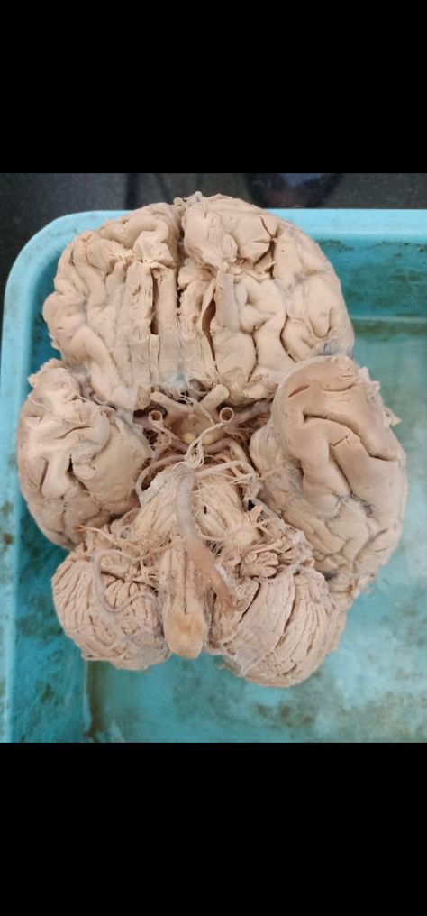 Brain specimen - dissection of brain- dental anatomy - anatomy Dissection Aesthetic, Brain Dissection, Dental Anatomy, Art Major, The Brain, Anatomy, Brain, Medicine, Stuffed Mushrooms