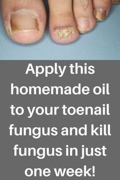 Fungal Nail Infections Infected Toenail, Toenail Health, Nail Remedies, Fingernail Fungus, Toenail Fungus Remedies, Nail Fungus Remedy, Nail Infection, Homemade Oil, Fungal Nail