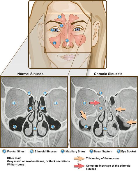 Sinuses and Sinusitis | Front view illustration and side-by-… | Flickr Mucus In Throat, Acute Sinusitis, Remedy For Sinus Congestion, Sinus Remedies, Home Remedies For Sinus, Maxillary Sinus, Sinus Congestion Relief, Chronic Sinusitis, Nasal Septum