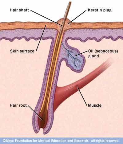 Keratosis pilaris develops when keratin forms a scaly plug that blocks the opening of the hair follicle. Usually plugs form in many hair follicles, causing patches of rough, bumpy skin.  - Mayo Clinic Infected Ingrown Hair, Glycolic Acid Cream, Sebaceous Filaments, Keratosis Pilaris, Bumpy Skin, Chicken Skin, Roots Hair, Ingrown Hair, Perfect Skin