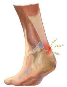 Insertional Achilles Tendinosis, Achilles Exercises, Achilles Bursitis, Achilles Stretches, Achilles Injury, Achilles Tendon Ruptures, Achilles Pain, Soft Tissue Injury, Achilles Tendon