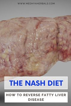 Liver Diet Plan, Foods For Liver Health, Liver Healthy Foods, Liver Diet Recipes, Healthy Liver Diet, What Should I Eat, Heal Liver, Tips Diet, Liver Recipes