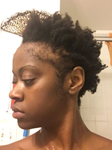 Bald Sides Hairstyles Black Women, Wigs For Alopecia For Women, Hairstyle For Balding Woman, Hairstyles For Black Women With Alopecia, Bald Baddie Black Women, Bald Edges Hairstyles Black Women, Traction Alopecia Regrowth, Bald Women Black, Traction Alopecia Hairstyles