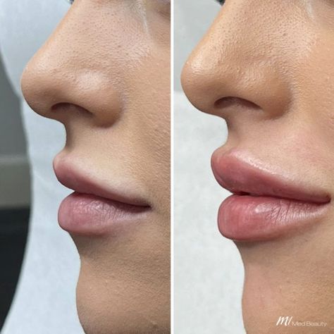 Hip Filler, Natural Lip Fillers, Lip Fillers Juvederm, Natural Filler, Lip Surgery, Lips Inspiration, Botox Lips, Large Lips, Facial Contouring