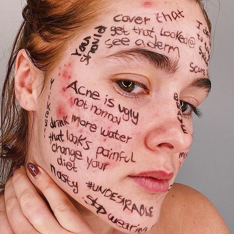 Body Positivity ✨ on Instagram: “PSA: acne is normal & it's nothing to be ashamed of. 🙍‍♀️⠀⠀⠀⠀⠀⠀⠀⠀⠀ via: @myfacestory” Acne Is Normal, Imperfection Photography, Beautiful Acne, Acne Positivity, Skin Positivity, Positivity Art, Skincare Acne, Real Skin, Cystic Acne