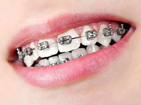 I wore silver bands on my silver braces so that colors didn't exaggerate my braces. Black Braces Teeth, Orthodontics Marketing, White Braces, Silver Braces, After Braces, Black Braces, Cute Braces Colors, Misaligned Teeth, Adult Braces