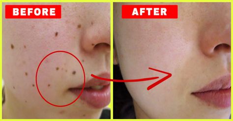 Moles On Face, Skin Lesions, Red Moles, Skin Moles, Mole Removal, Home Remedies For Acne, Acne Remedies, Skin Remedies, How To Get Rid Of Acne