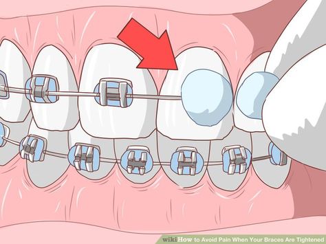 Foods To Eat With Braces Soft, How To Eat With Braces, Soft Foods To Eat After Getting Braces, Foods For Braces Soft, Food For Braces For Kids, Soft Food After Braces, Food With Braces, Braces Friendly Food, Food To Eat With Braces