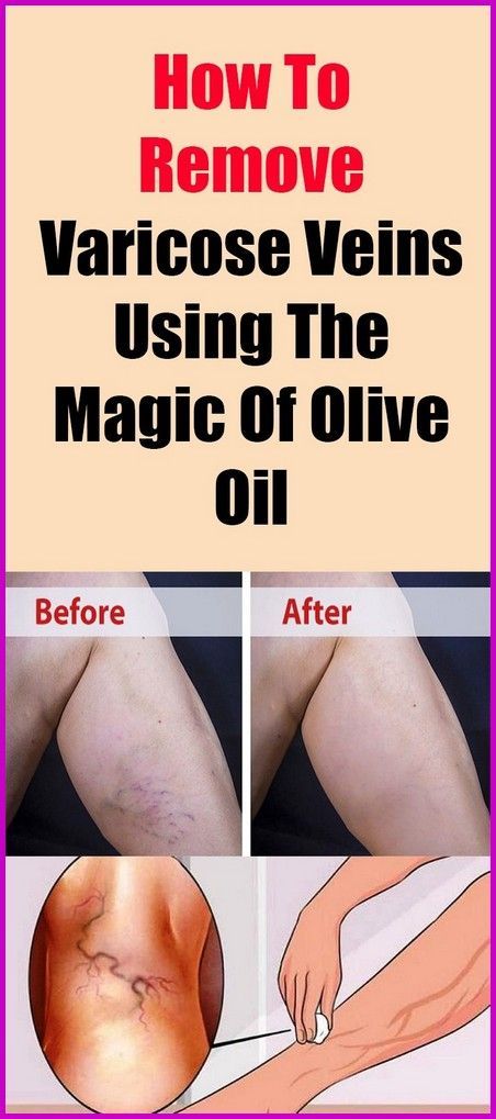 How To Remove Varicose Veins Using The Magic of Olive Oil Vericous Veins, Varicose Vein Removal, Best Bodybuilding Supplements, Varicose Vein Remedy, Leg Veins, Vein Removal, Castor Oil Benefits, Home Medicine, Lymph Drainage