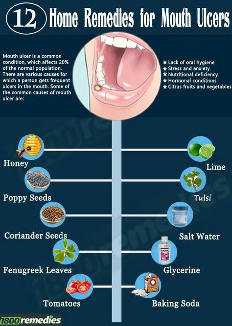 Ulcer Remedies, Vitamins Chart, Illness Remedies, Ulcer Remedies Mouth, Canker Sore Remedy, Mouth Ulcer, Remedies For Dry Mouth, Most Delicious Food, Healthy Mouth