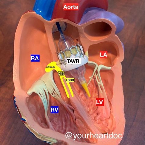 Ali Haider MD, FACC on Instagram: “Today’s TAVR Tuesday tidbit! . . So why do we see heart block more often with TAVR than with surgical valves? . Although the degree of…” Tricuspid Valve, Interventional Cardiology, Nurse Things, Mitral Valve, Heart Blocks, Human Anatomy And Physiology, Med Student, Cardiology, Medical Education