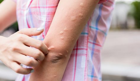 4 surprising reasons mosquitoes attack you Hives Causes, O Positive Blood, Chronic Hives, The Hives, Heat Rash, Skin Bumps, Muscle Abdominal, Itching Skin, Mosquito Bite