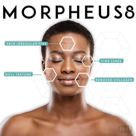 Morpheus 8 Before And After Face, Morpheus 8 Before And After, Morpheus 8, Garage Playroom, Rf Microneedling, Early Adopters, Skin Resurfacing, Facial Plastic, Anti Aging Facial