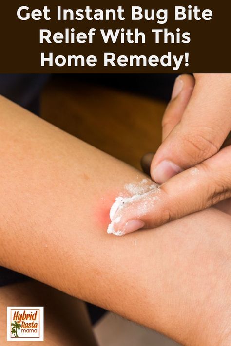 How To Stop Bug Bites From Itching, Stop Bug Bites From Itching, How To Treat A Bee Sting, Diy Bug Bite Itch Relief, Bee Stings Relief Swelling, Bee Sting Remedies, Bee Sting Remedy, Bee Sting Swelling, Bug Bite Swelling