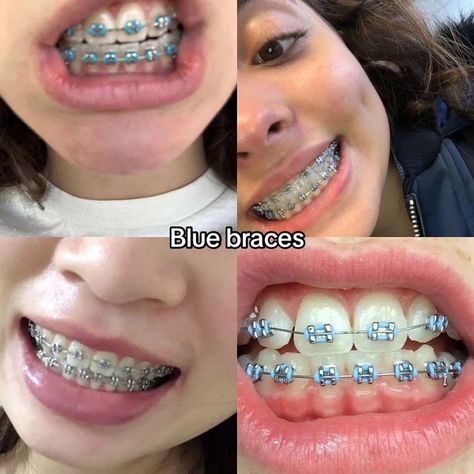 Braces Aesthetic Purple, Braces Colors Navy Blue, Cute Color Braces Ideas, Braces Sky Blue, Blue Braces Aesthetic, Braces Inspo Aesthetic, Blue Braces Colors, Braces Ideas Colors, Best Color Braces