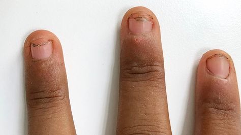 Onycholysis: Causes, Symptoms, and Treatments Bitten Nails, Nail Disorders, Nail Falling Off, Best Summer Nail Color, Fast Nail, Lip Care Routine, Nail Bed, Nails Only, Nails For Kids